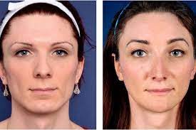 Different Approaches to Facial Feminization Surgery